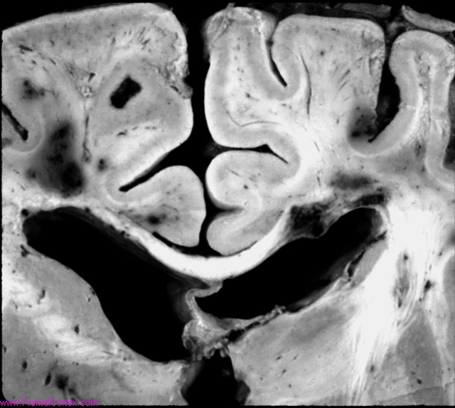 Multiple cavernous  malformations, familial, cerebrum